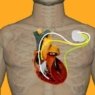 HULW-UFPB/HU Brasil inicia nova etapa no atendimento com implante de marcapasso em pacientes atendidos pelo SUS  